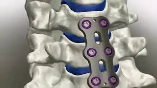 HumanTech: Cervical Plate System