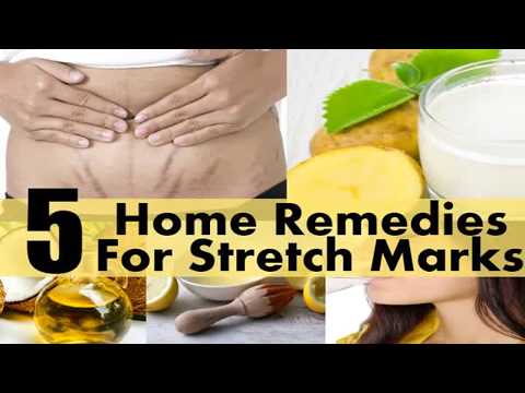 Easy Yet Effective Remedies For Stretch Marks |Tricky Tips|