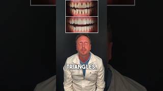 Fix your Black Triangles with the Bioclear Method! #bioclear #blacktriangles #cosmeticdentistry
