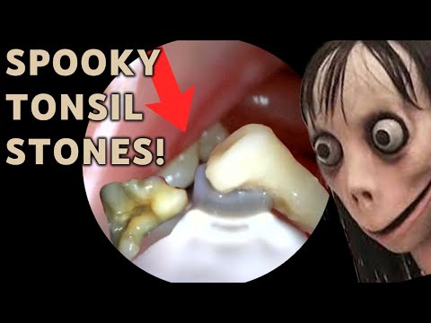 ANOTHER SPOOKY TONSIL STONE REMOVAL | AIM 32