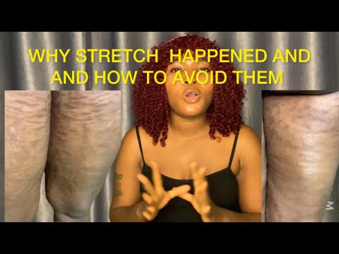 Why Stretch Marks Happen — and How to Avoid Them