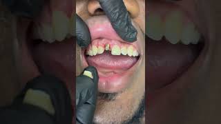 Single front tooth implant ❤️ Now you see it , now you don't!