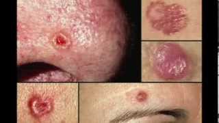 Some Basal Cell Skin Cancers Aggressive