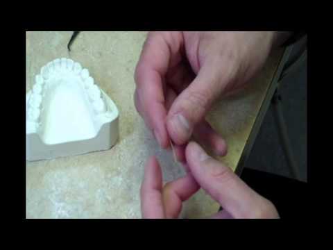 Fast Splint Matrix- Attelle Linguale Orthodontique- Technique Hybride