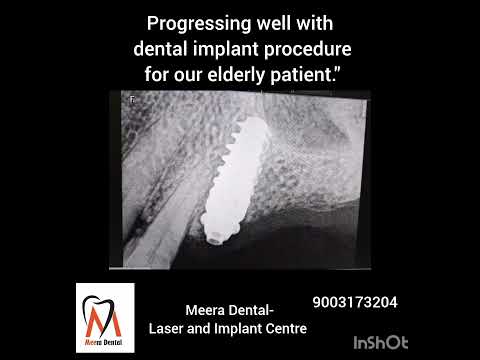 Implants are a viable option for replacing missing teeth of any age