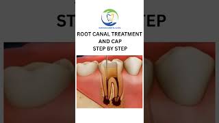 Root Canal Treatment #rootcanal #dentistry #dentist #savetooth #youtubeshorts #shorts #shortvideo