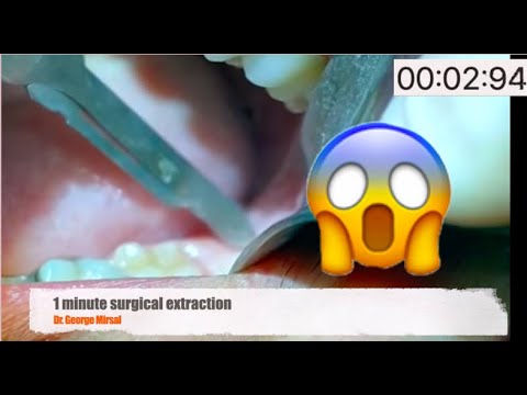 1 minute Surgical wisdom tooth extraction