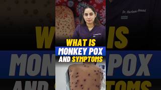 What Is Monkey POX Virus I Symptoms & Precautions