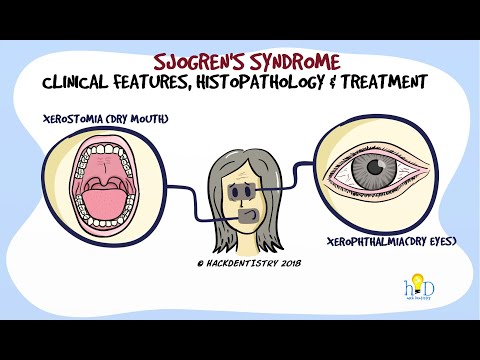 Sjogren's syndrome (Part 2) - Clinical features and Histopathology