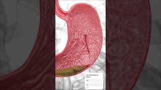 Stomach ulcer damaging #ppitutorial #ulcers #asmr #subscribe