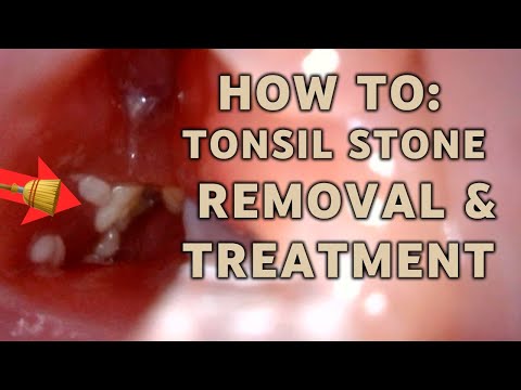 How to: Tonsil stone removal at home treatment | AIM 11