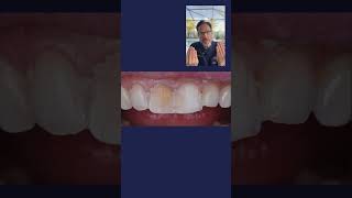 Dental Tip: How to Control Prep Depth for Porcelain Veneers with Precision