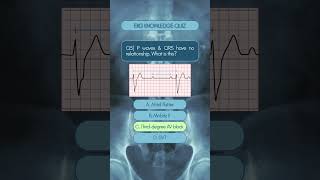 Test Your EKG Knowledge! Interactive ECG Quiz for Students & Clinicians 🫀 #medicine #doctor #heart