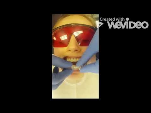 Invisalign journey