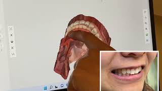 How To Diagnose Braces Cases Using Digital Impression