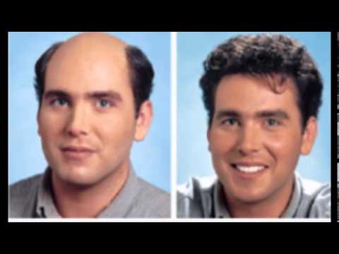 Safe & Convenient Hair Transplant In India